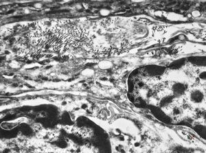 F,41y. | synovial metaplasia - capsule of implantate F,41y. | synovial metaplasia - capsule of implantate